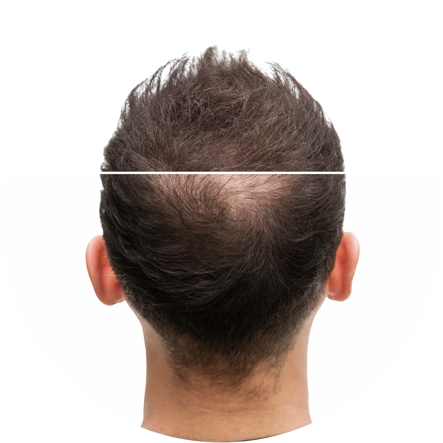 Haarvedichtung bei Männern